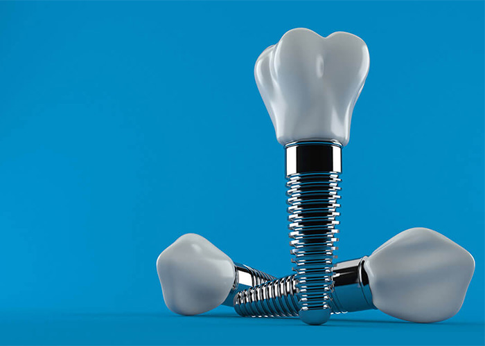 three dental implant models on a blue background