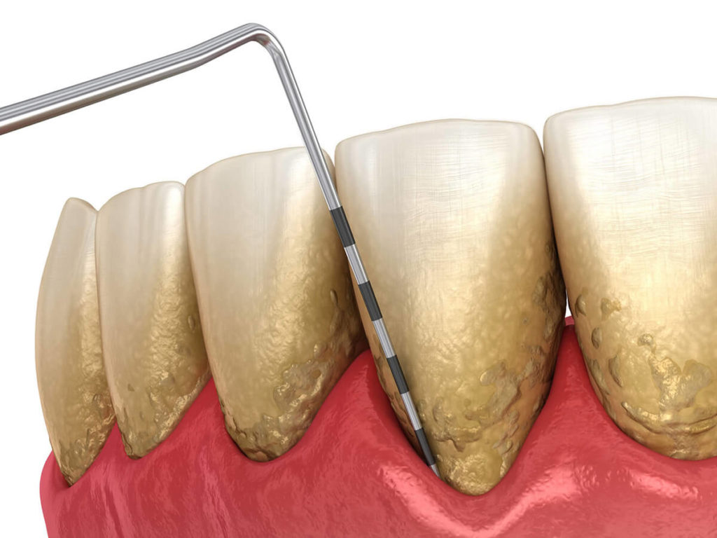 periodontal disease measurement