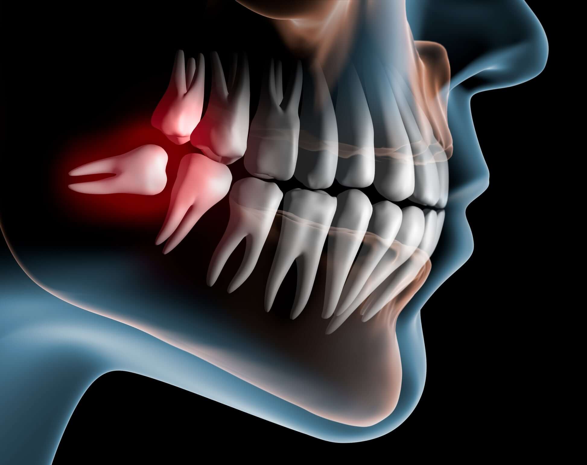 Wisdom Teeth Removal Tinley Park, IL Dentist Amazing Smiles